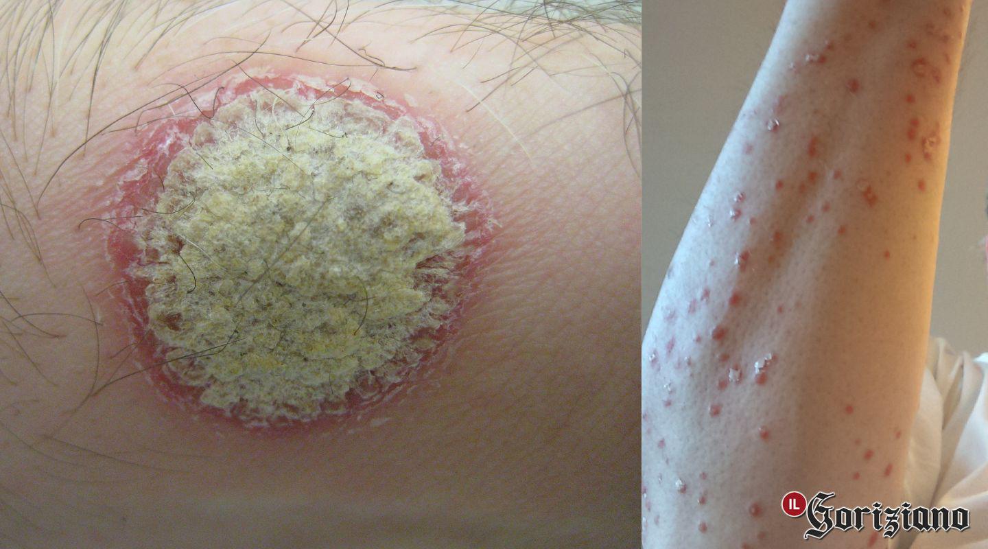 Psoriasi, 3 milioni di italiani colpiti: visite gratuite all'ospedale di Gorizia